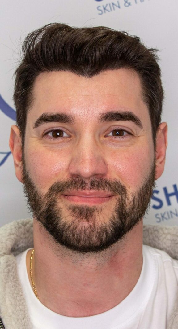 After Hair Transplant